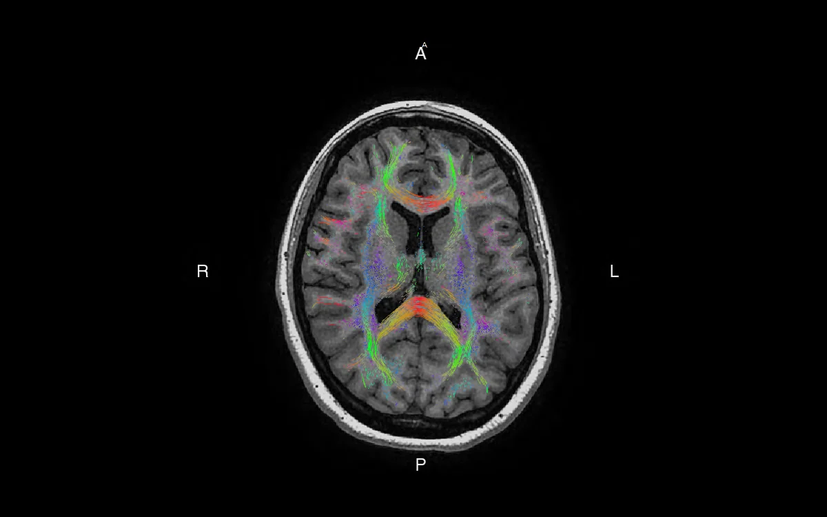Brain diffusion tensor imaging scan